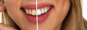 Как отбелить зубы в домашних условиях? Самый простой способ!